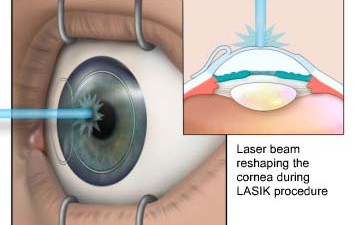 cheap-lasik-surgery-abroad