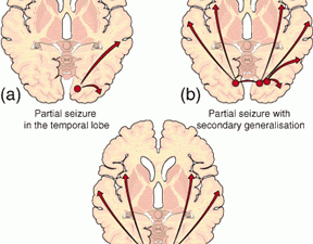 epilepsy