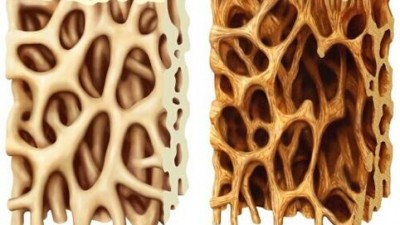 gambar-osteoporosis-8