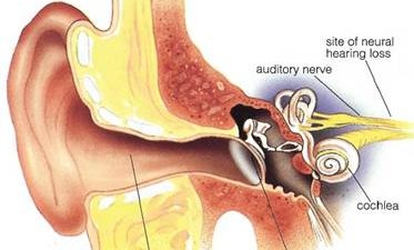 hearingloss