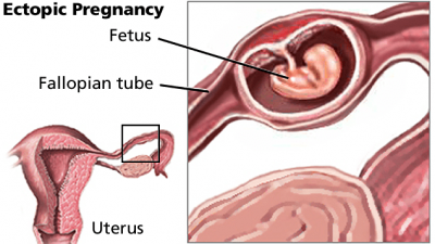 ectopic-pregnancy