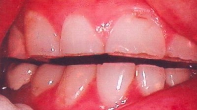 bruxism (1)