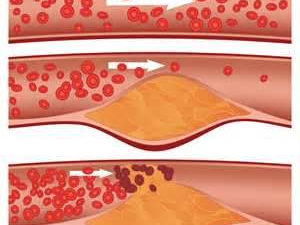 kolesterol-tinggi-penyebab-stroke-dan-serangan-jantung-1