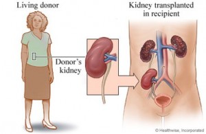 bagaimana-menjadi-donor-untuk-transplantasi-ginjal-1