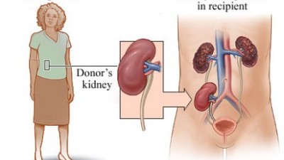 bagaimana-menjadi-donor-untuk-transplantasi-ginjal-1