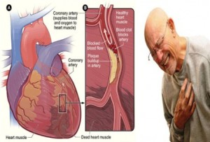 serangan-jantung-penyebab-dan-pengobatannya