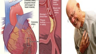 serangan-jantung-penyebab-dan-pengobatannya