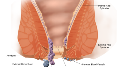 wasir-ambeien-hemoroid