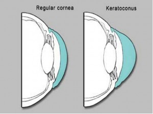 Apa Itu Keratoconus