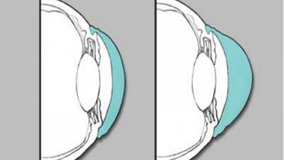 Apa Itu Keratoconus