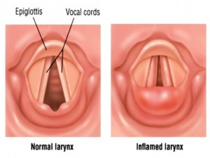 apa-itu-laringitis