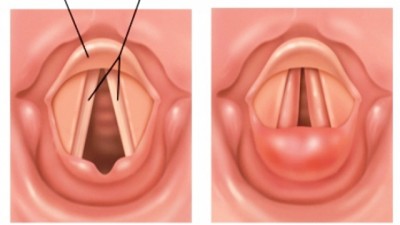 apa-itu-laringitis