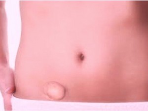 Hernia Inguinal (Turun Berok)