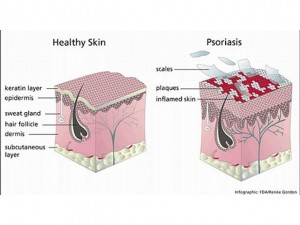 Psoriasis - Bukan Gatal Biasa