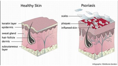 Psoriasis - Bukan Gatal Biasa