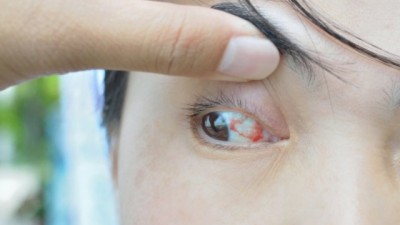 Jenis Pinkeye (Konjungtivitis)