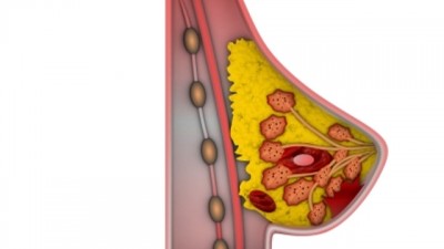 Mendeteksi Kanker Payudara Sedini Mungkin