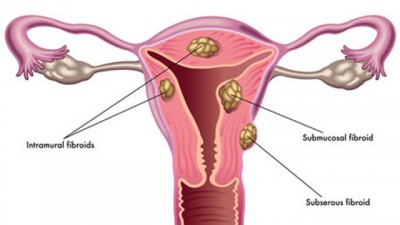 Apa Yang Terjadi Pada Uterine Fibroid dan Kapan Waktunya Periksa Ke Dokter