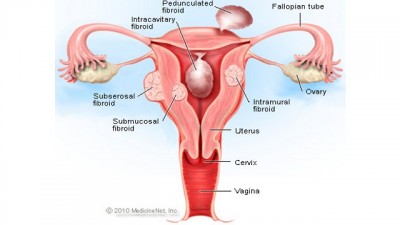 Penyebab Dan Gejala Uterine Fibroids