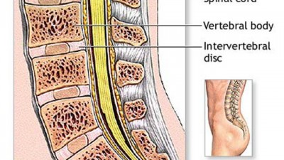 HNP (Hernia Nukleus Pulposus) 2