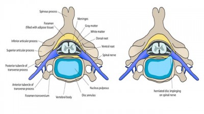 HNP (Hernia Nukleus Pulposus))