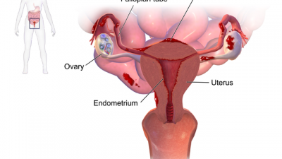 Apa Itu Endometriosis 1