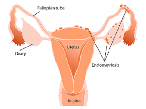 Apa Itu Endometriosis 2