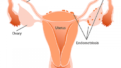 Apa Itu Endometriosis 2