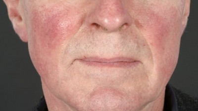 Kulit Anda Dan Rosacea Bagian 1