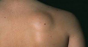 LIPOMA